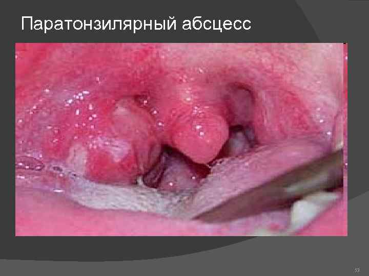 Паратонзилярный абсцесс 53 
