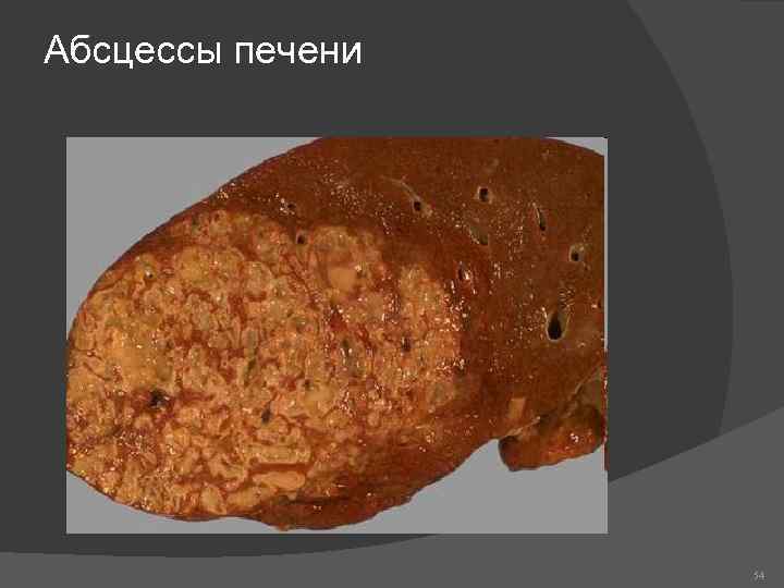 Абсцессы печени 54 