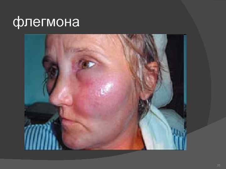 флегмона 57 
