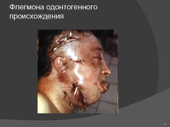Флегмона одонтогенного происхождения 58 
