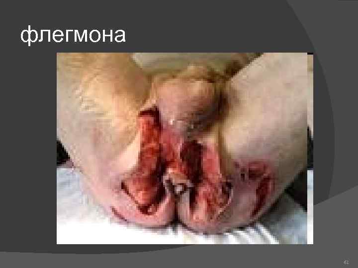 флегмона 61 