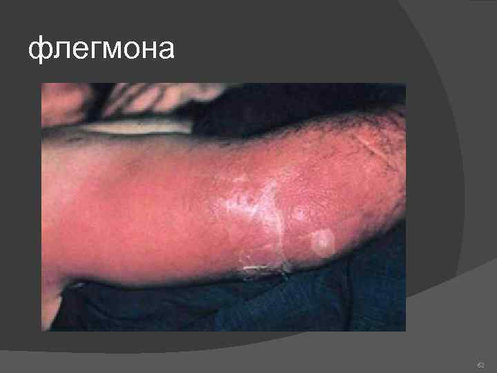 флегмона 62 