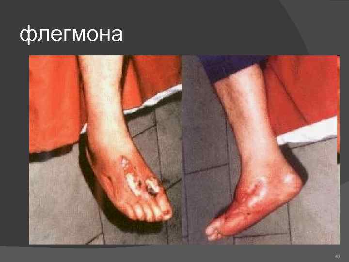 флегмона 63 