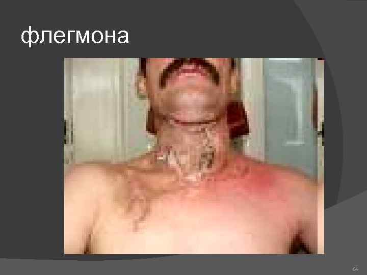 флегмона 64 