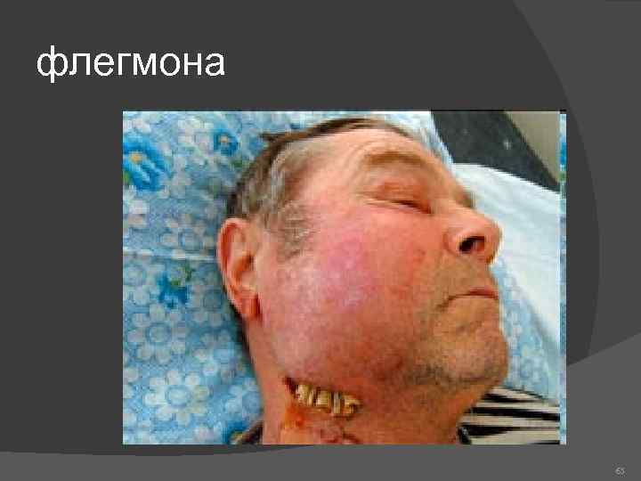 флегмона 65 