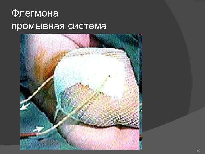 Флегмона промывная система 66 