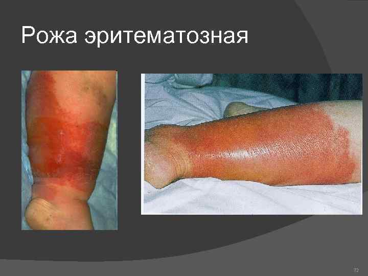 Рожа эритематозная 72 