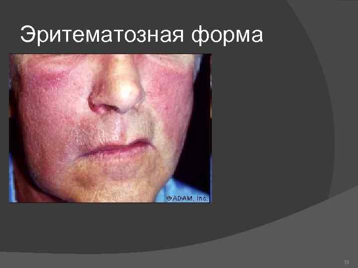 Эритематозная форма 73 