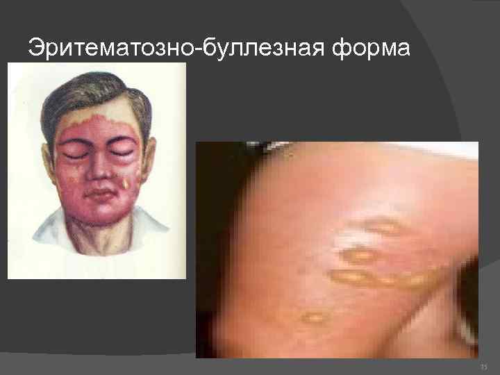 Эритематозно-буллезная форма 75 
