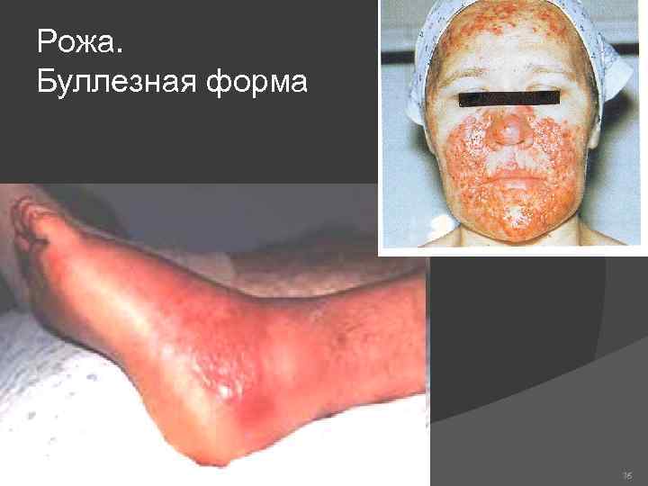 Рожа. Буллезная форма 76 