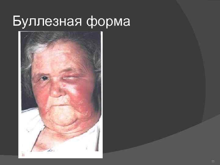 Буллезная форма 77 