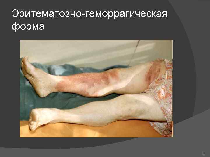Эритематозно-геморрагическая форма 78 