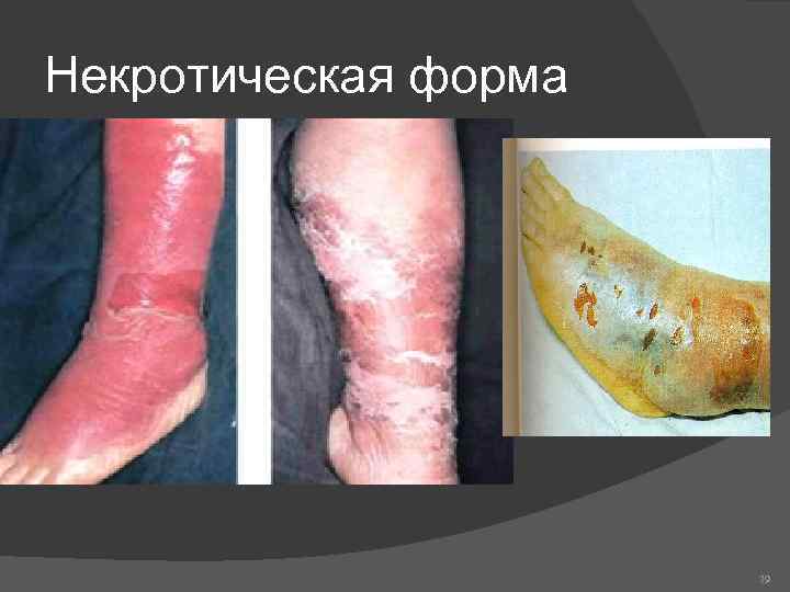 Некротическая форма 79 