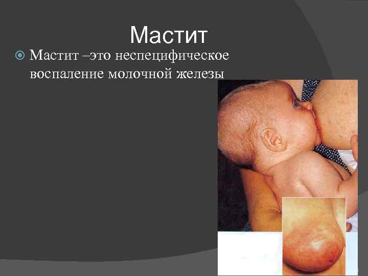 Мастит –это неспецифическое воспаление молочной железы 84 
