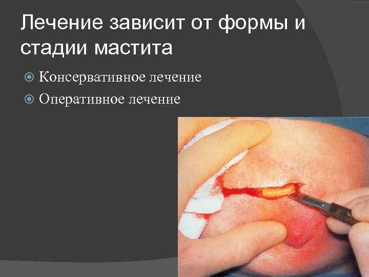 Лечение зависит от формы и стадии мастита Консервативное лечение Оперативное лечение 89 