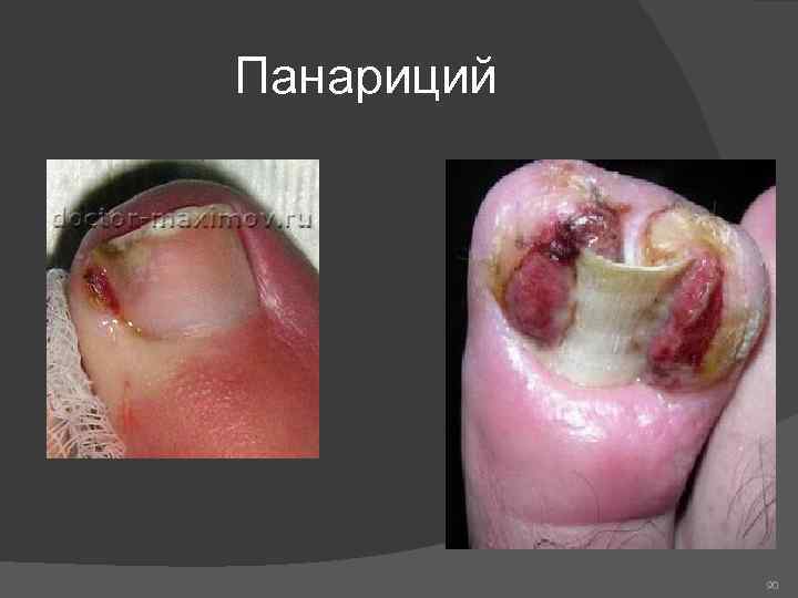 Панариций 90 