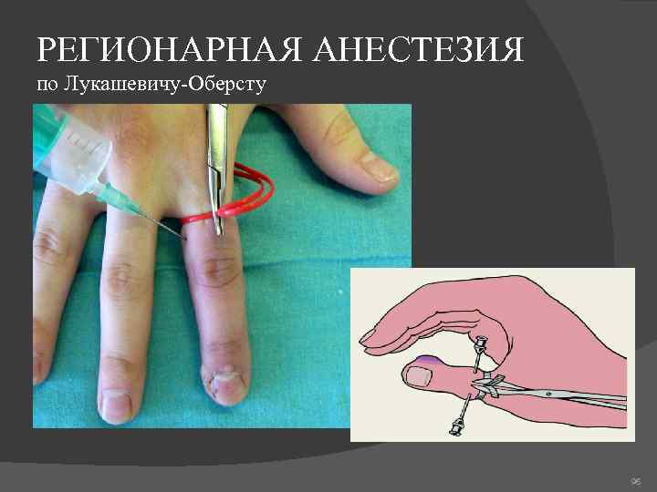 РЕГИОНАРНАЯ АНЕСТЕЗИЯ по Лукашевичу-Оберсту 96 