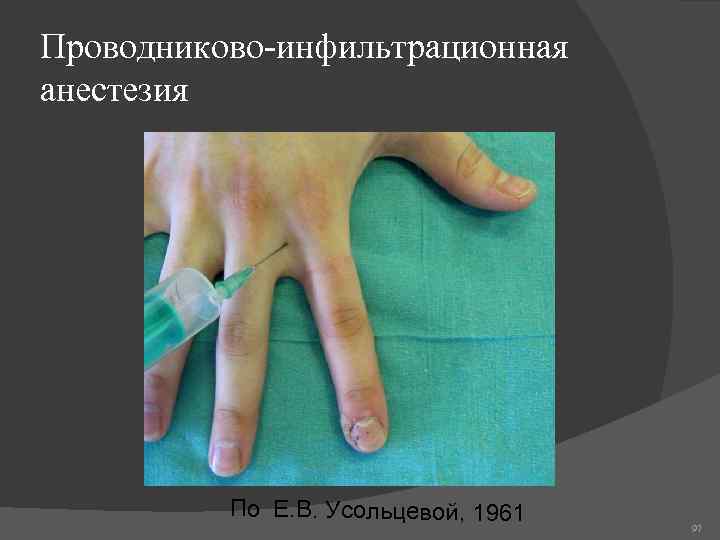 Проводниково-инфильтрационная анестезия По Е. В. Усольцевой, 1961 97 