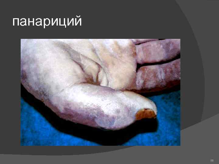 панариций 98 