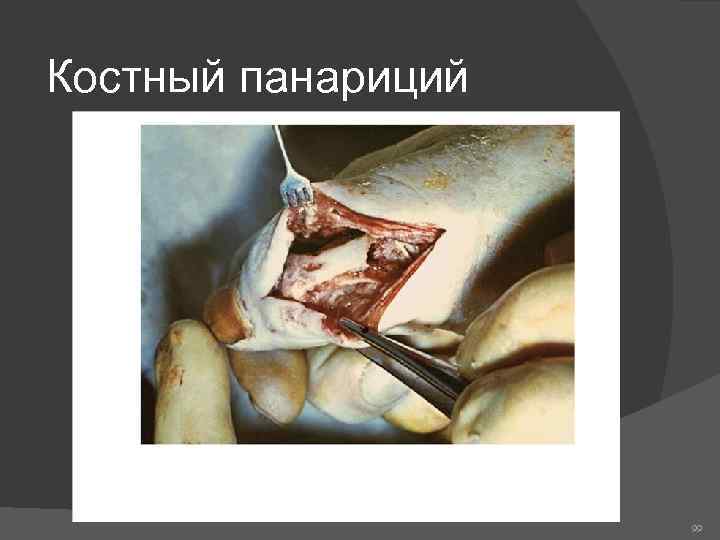 Костный панариций 99 