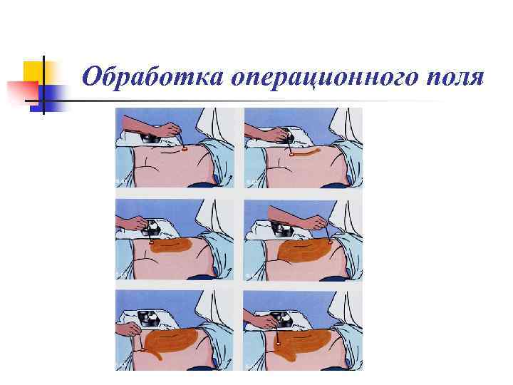 Обработка операционного поля 