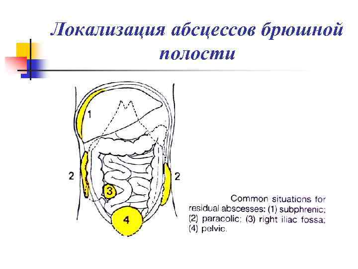 Локализация абсцессов брюшной полости 
