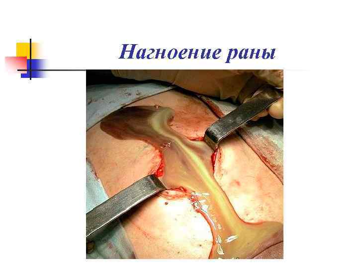Нагноение раны 