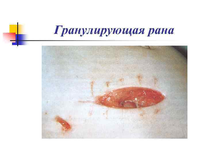Гранулирующая рана 