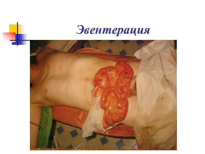 Эвентерация 