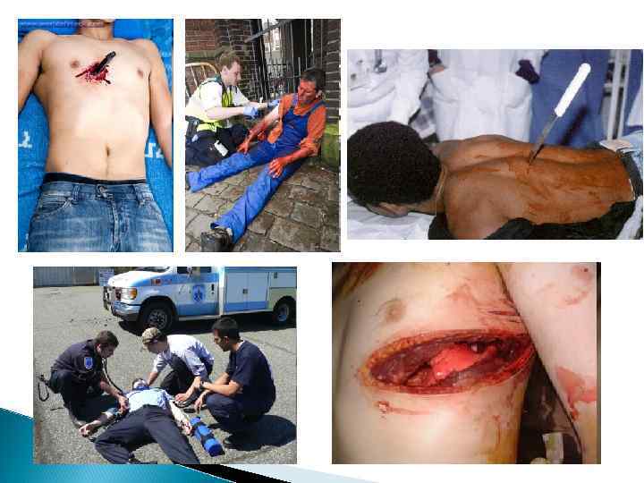 Ушиб мягких тканей грудной клетки Клиника: Общее состояние не страдает; Местно: припухлость, боль усиливается