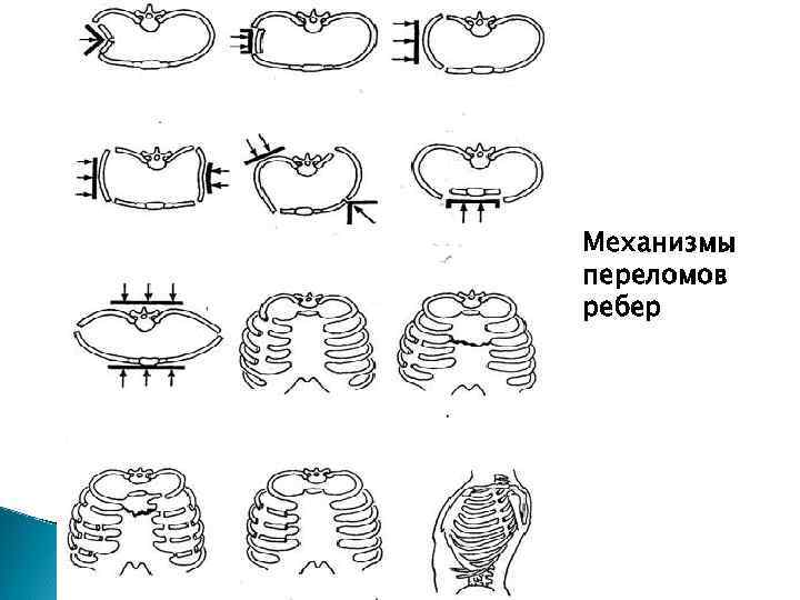 Закрытый перелом ребра карта вызова