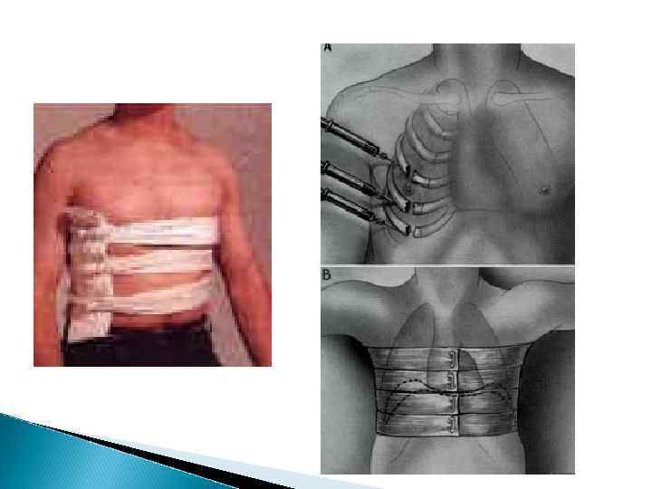 Пневмоторакс и травматическая эмфизема 1 — разрыв трахеи: 2 — разрыв бронха); 3 —