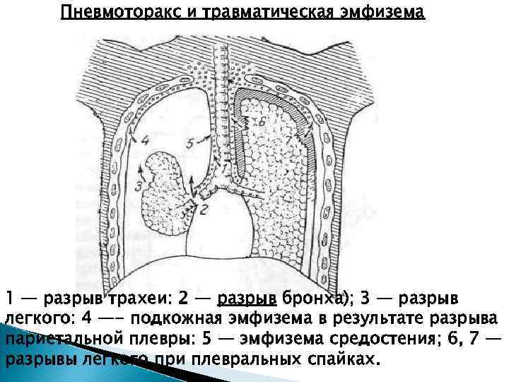 Спонтанный пневмоторакс развивается без какой-либо предшествующей травмы. Не осложненный спонтанный пневмоторакс является следствием разрыва