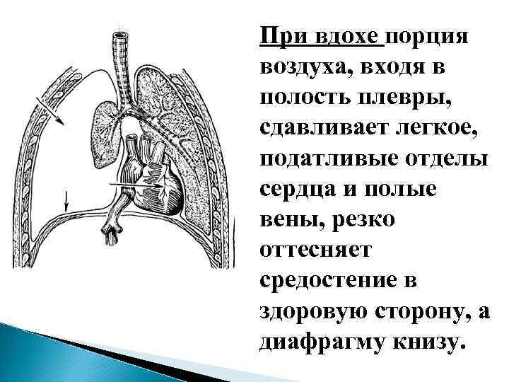 Механизм развития парадоксального дыхания при открытом пневмотораксе: на вдохе воздух дополнительно поступает в плевральную