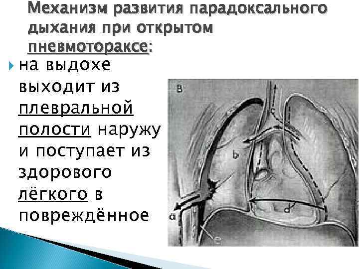 Тупая травма грудной клетки карта вызова