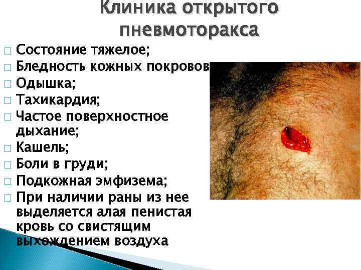 При вдохе воздух на стороне повреждения нагнетается в плевральную полость через рану грудной стенки