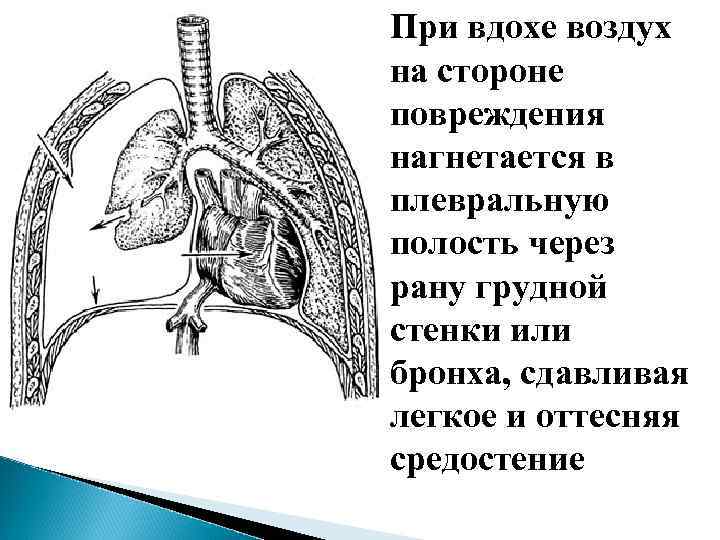 Напряженный пневмоторакс служит показанием к немедленной пункции и дренированию плевральной полости. Если технически неотложное