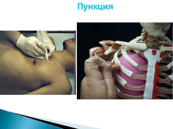 Гемоторакс Это скопление излившейся свободной крови в плевральную полость - может наблюдаться при повреждении