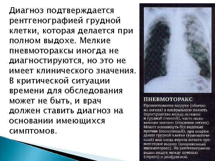 ПРИЗНАКИ ГЕМОТОРАКСА: отсутствие дыхательных шумов над поврежденной половиной грудной клетки. Кожа бледно-синюшная в результате