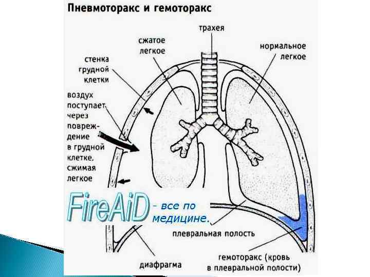 Презентация на тему травмы грудной клетки