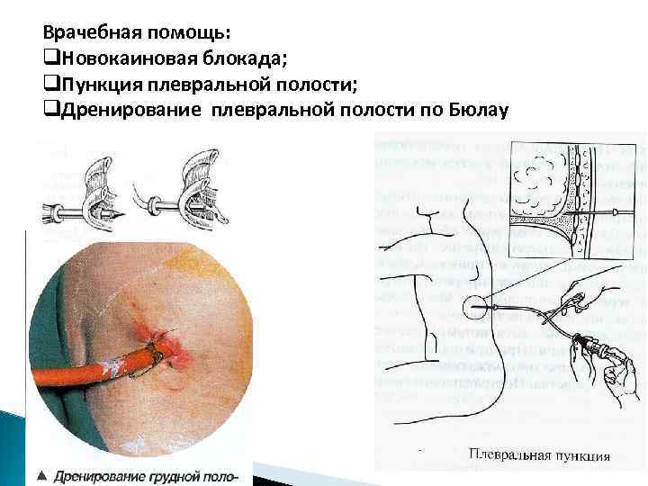 При вывихах акромиального конца ключицы нарушается функция руки – чаще всего невозможно поднять руку