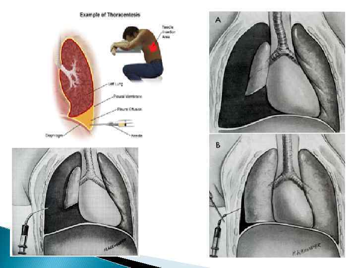 Симптомы Вокруг ключицы возникает синяк (его ошибочно называют гематомой, но на самом деле это