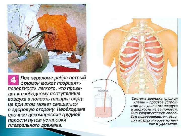 Диагностика целесообразно выполнять рентгенограмму не одного плеча, а двух сразу – что позволит оценить