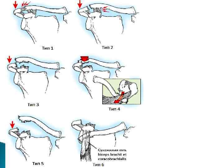 Неотложная помощь Успокоить Усадить Обезболить Наложить повязку Дезо или кольца Дельбе Холод Транспортировка в