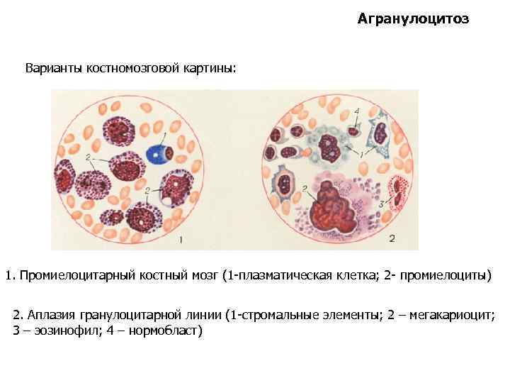 Агранулоцитоз Варианты костномозговой картины: 1. Промиелоцитарный костный мозг (1 -плазматическая клетка; 2 - промиелоциты)