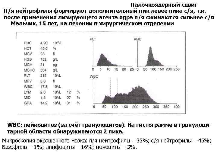 Палочкоядерный сдвиг П/я нейтрофилы формируют дополнительный пик левее пика с/я, т. к. после применения