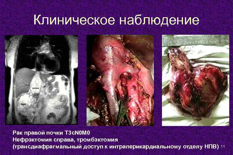 Клиническое наблюдение Рак правой почки T 3 c. N 0 M 0 Нефрэктомия справа,