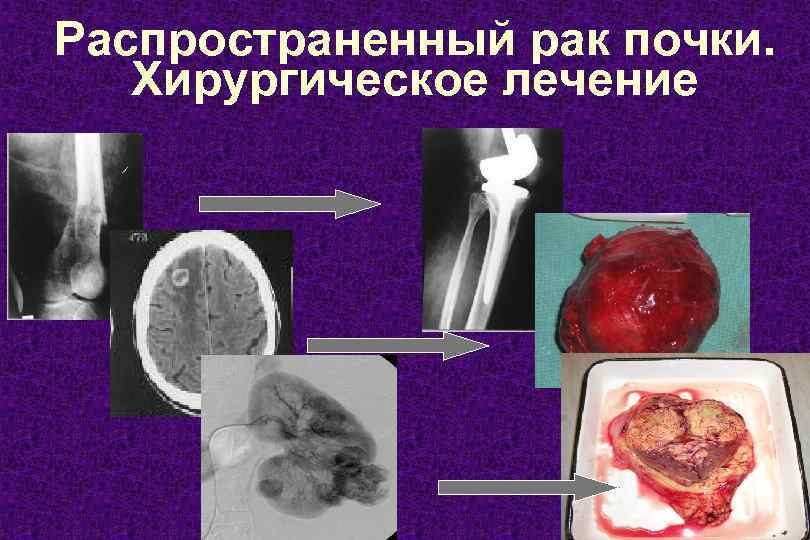 Распространенный рак почки. Хирургическое лечение 13 