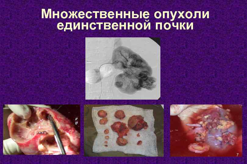 Множественные опухоли единственной почки 7 