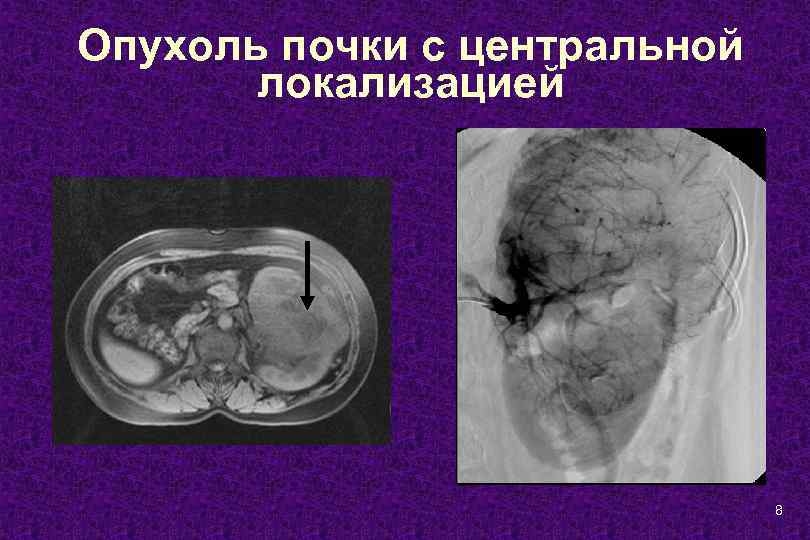 Опухоль почки с центральной локализацией 8 